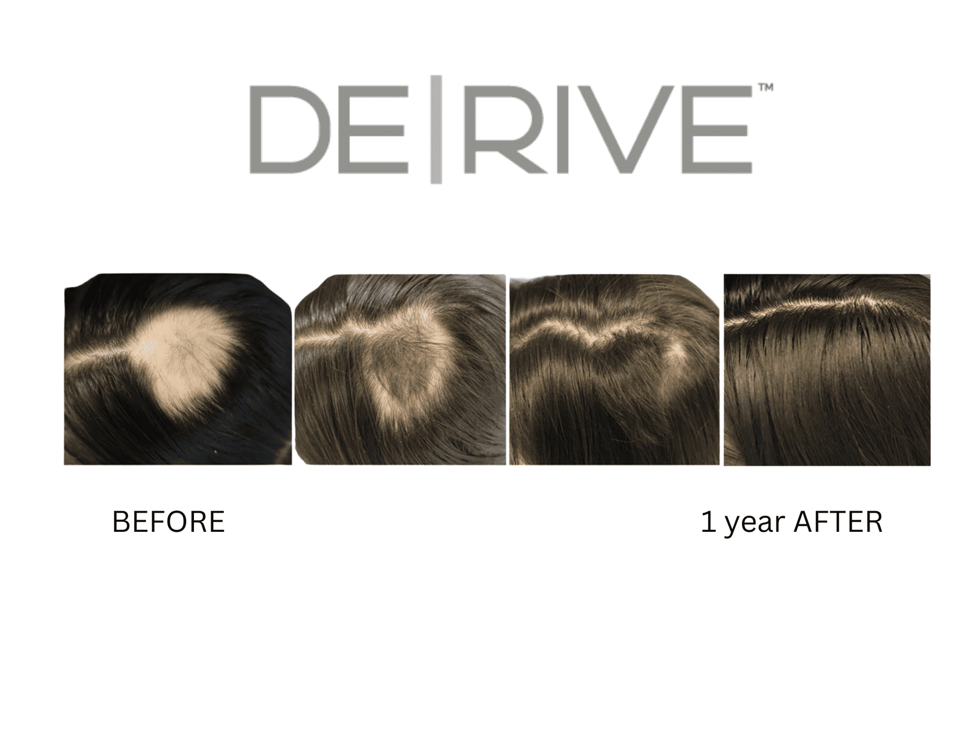 Before and after hair treatment results over one year, with noticeable improvement.